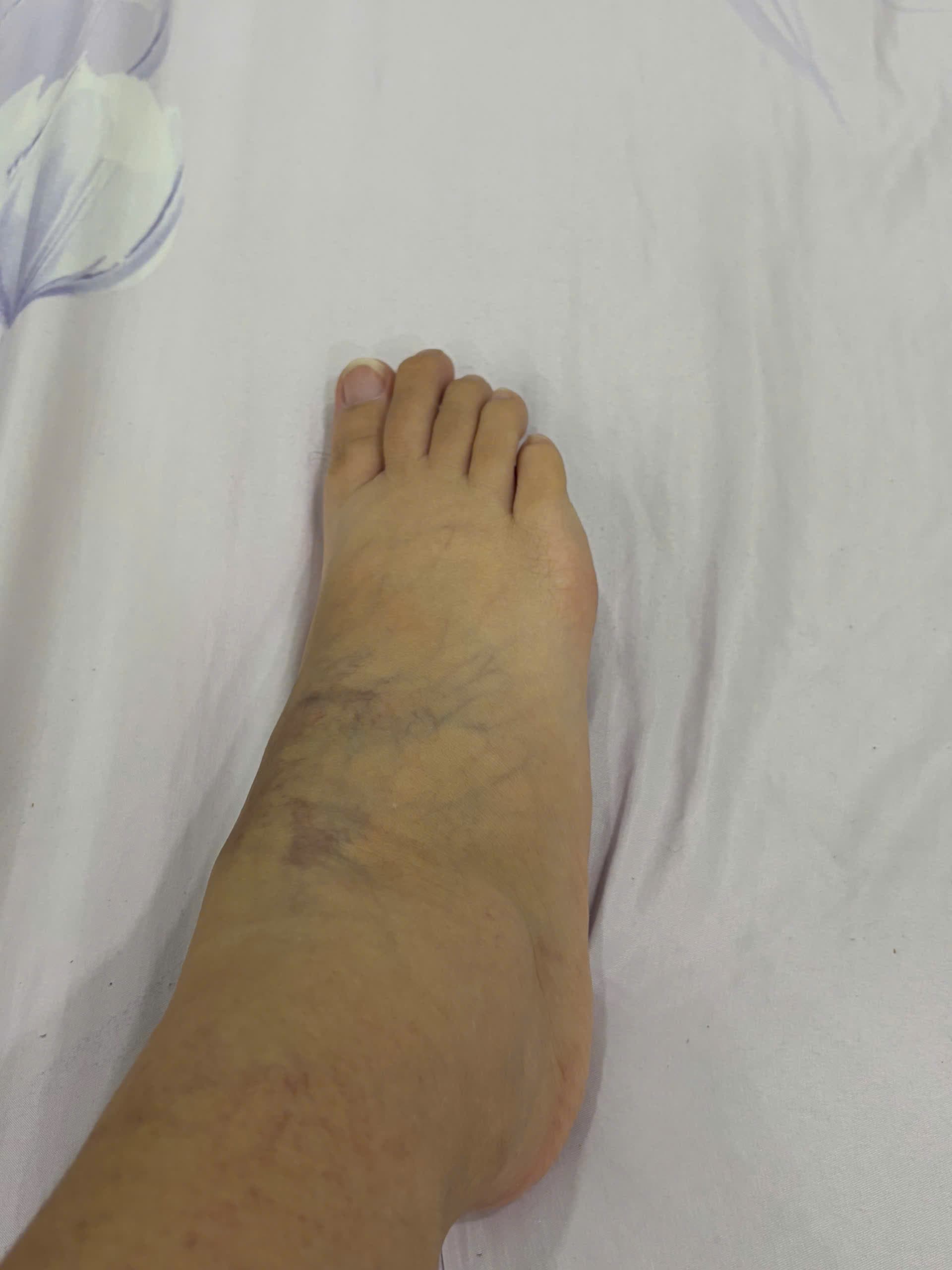 Ngoc Huynh varicose veins after Vista Care